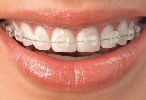 ortodoncia en Aguilar de Campoo